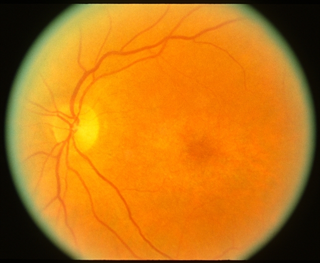 Chloroquine toxicity to